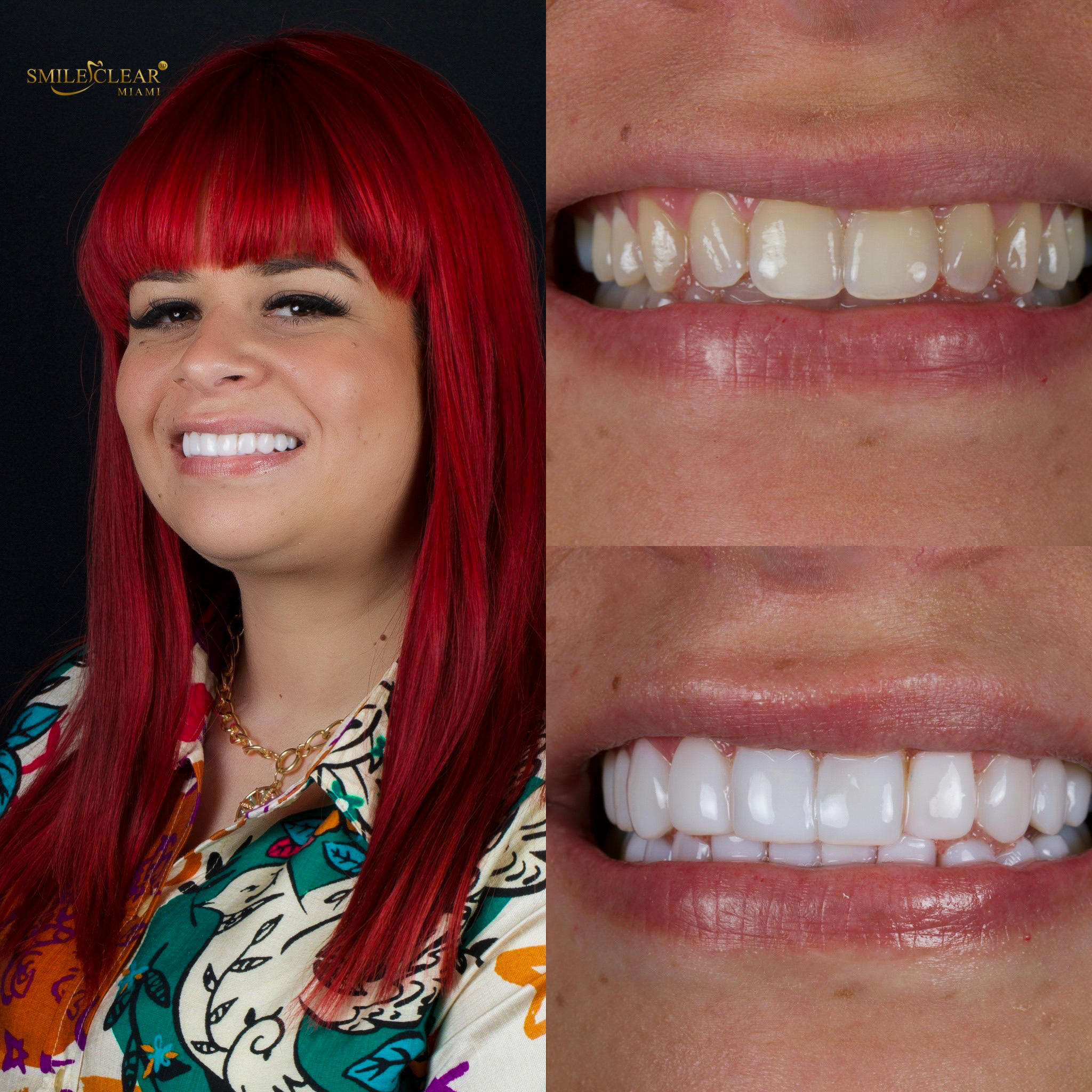 Before smile transformation