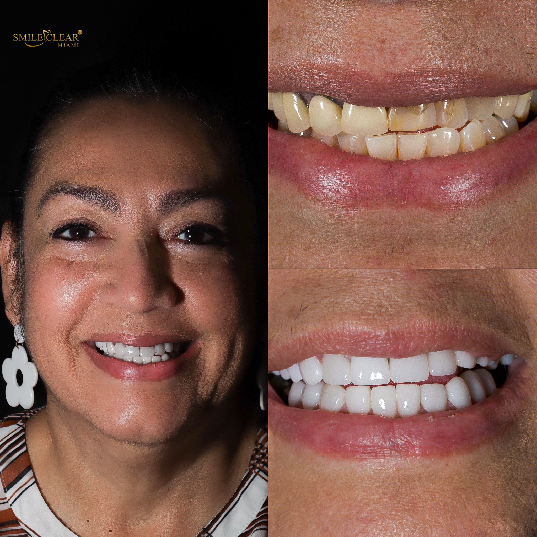 After smile transformation