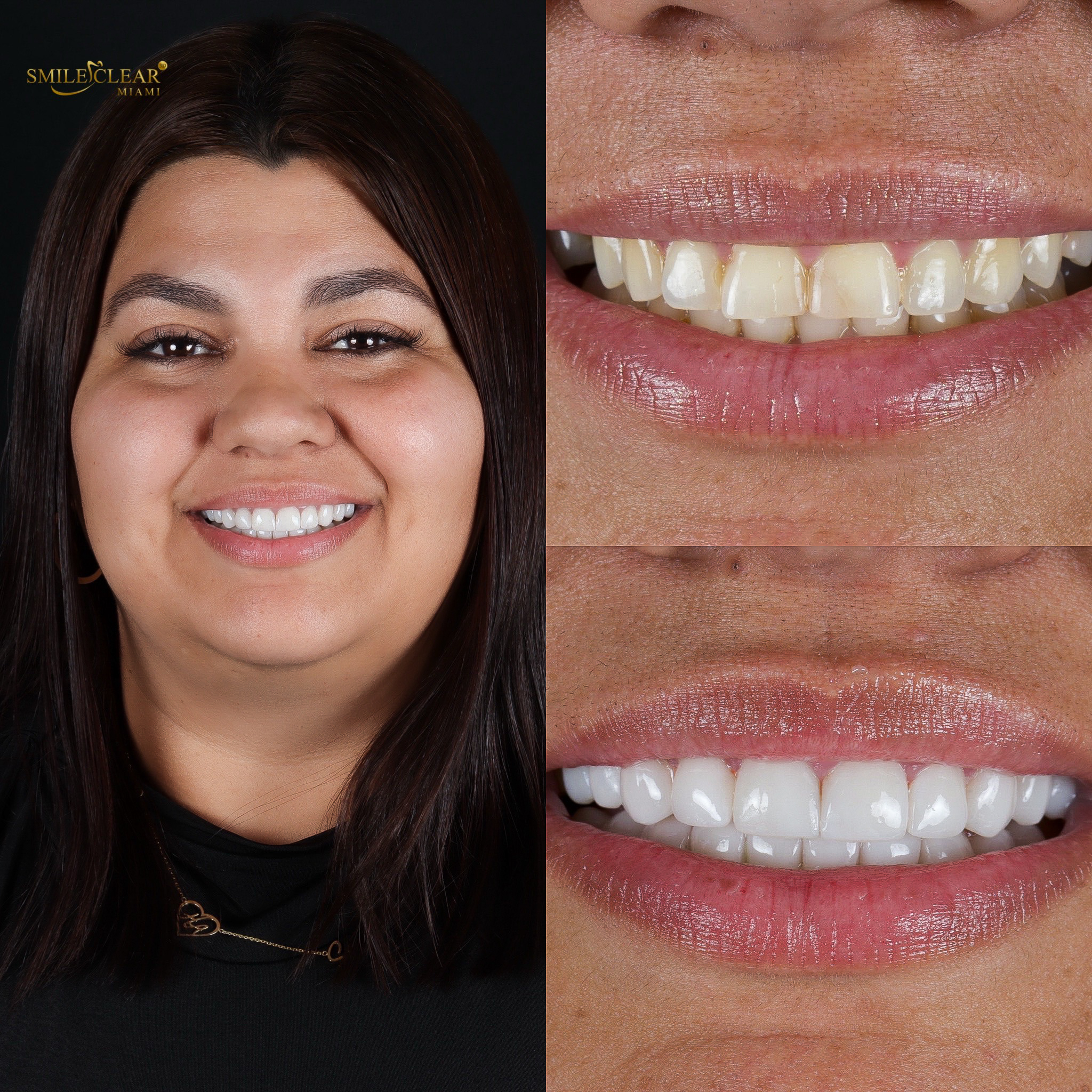 Before smile transformation