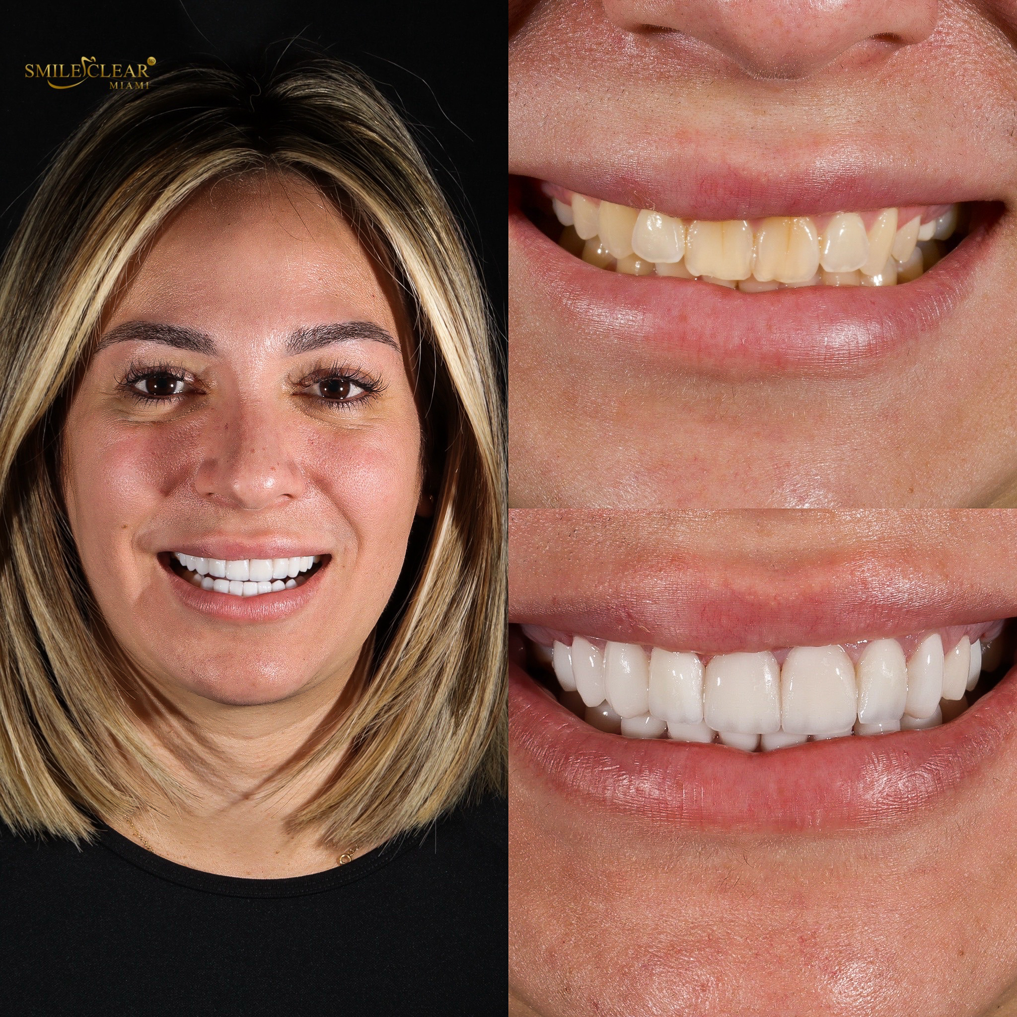 After smile transformation