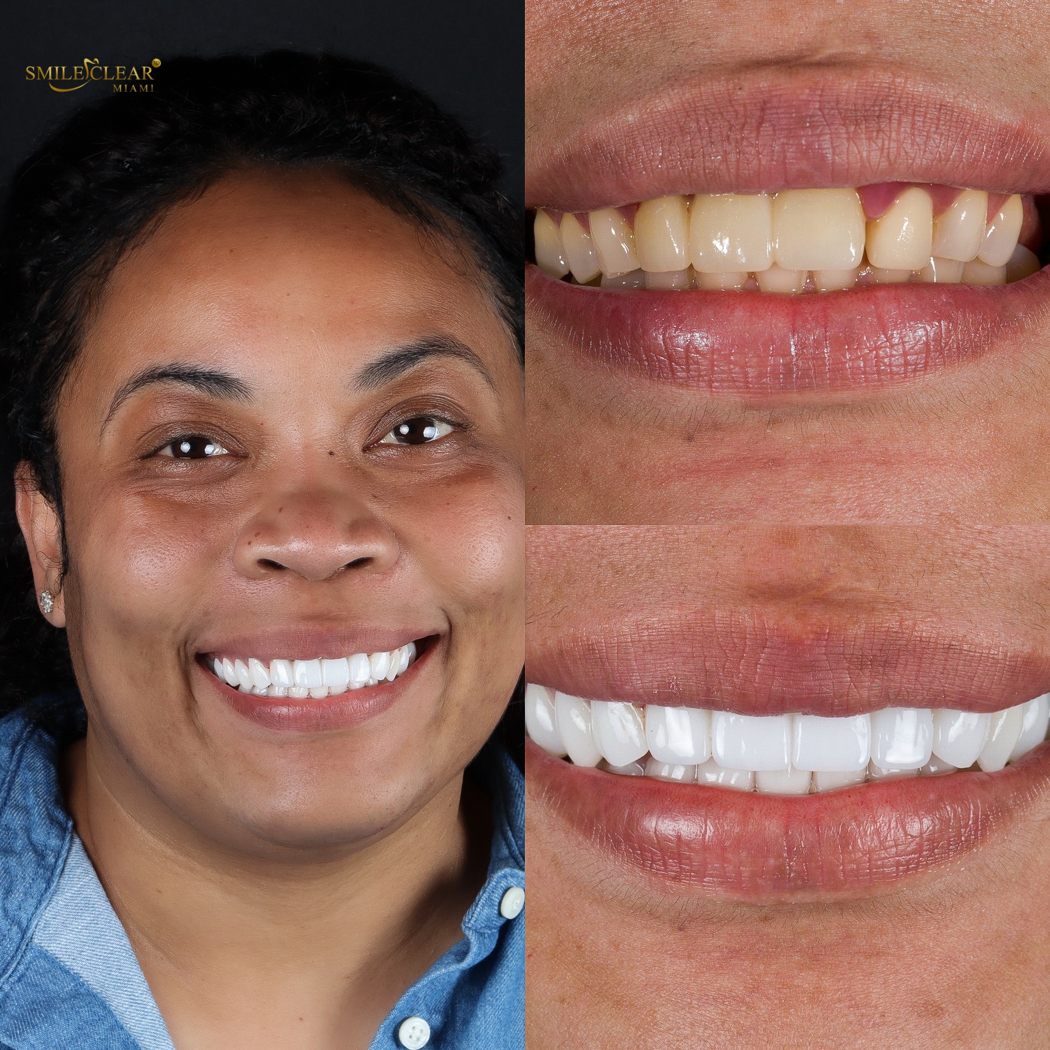 Before smile transformation