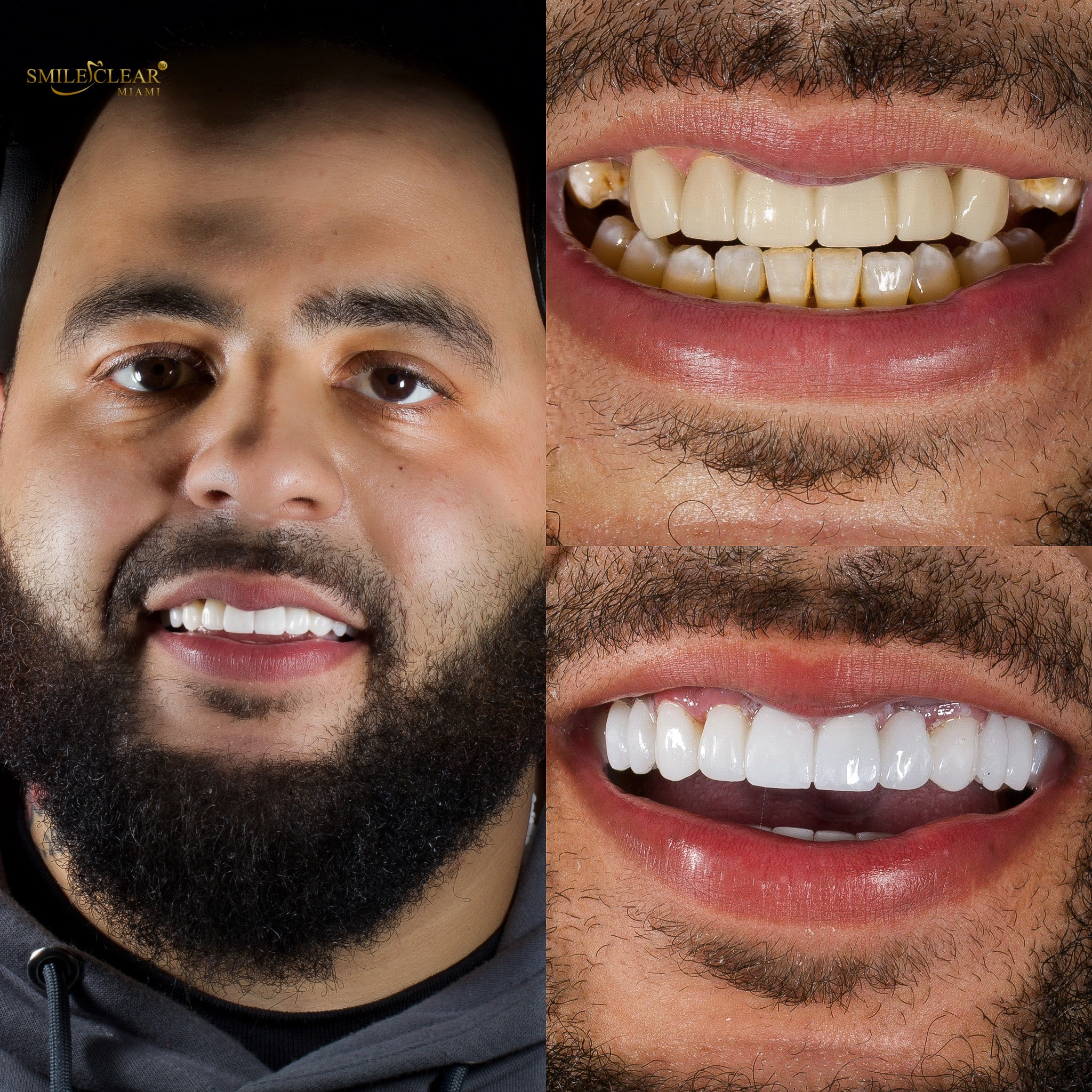 After smile transformation