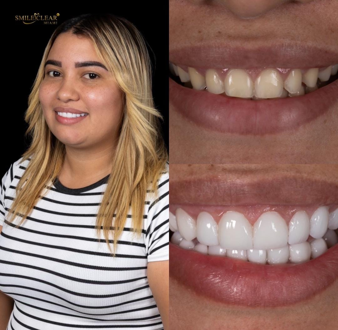 After smile transformation