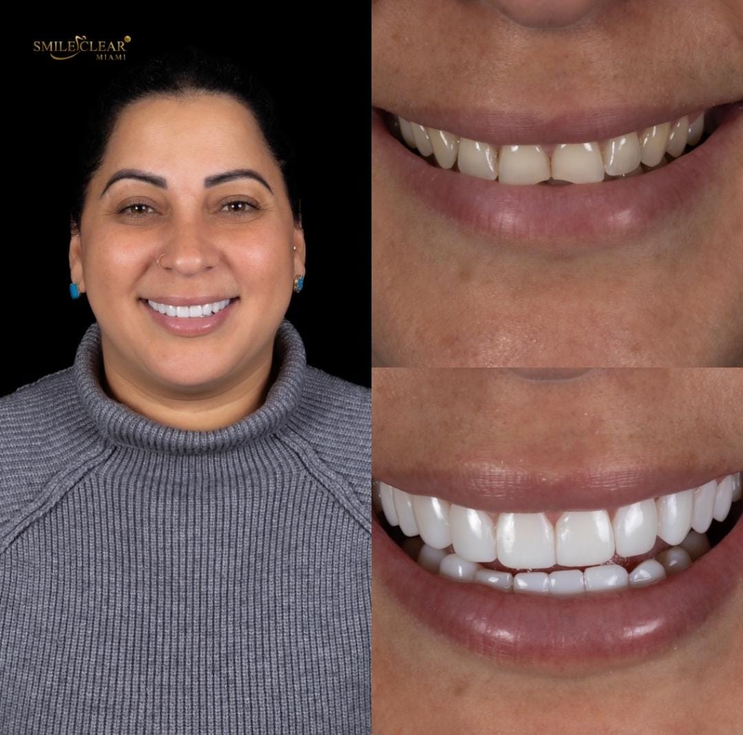 Before smile transformation