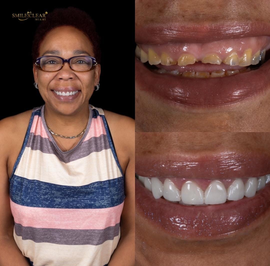After smile transformation