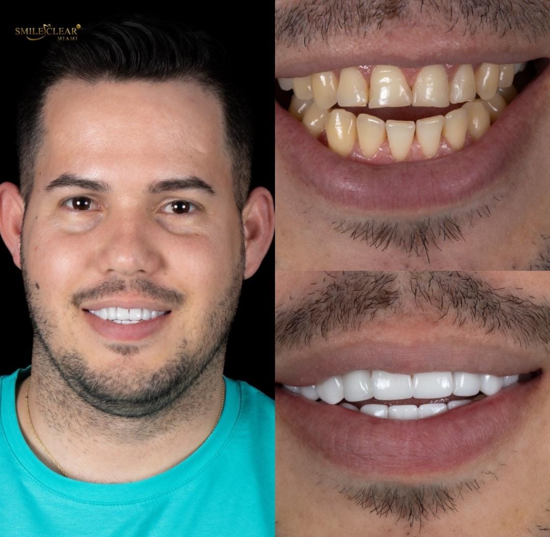 After smile transformation