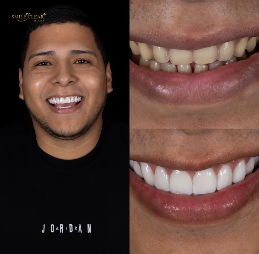 Before smile transformation
